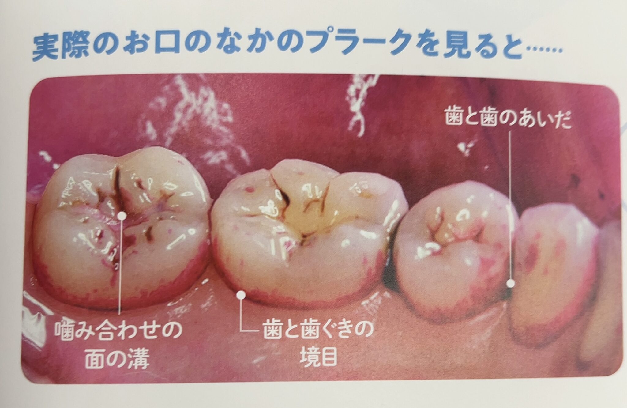 プラークって何？〜歯ブラシで効率良く落とす方法瘟〜｜北浦和の歯医者｜北浦和かねこ歯科クリニック