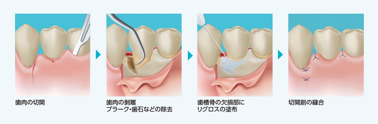 歯周再生療法（リグロス）保険適応